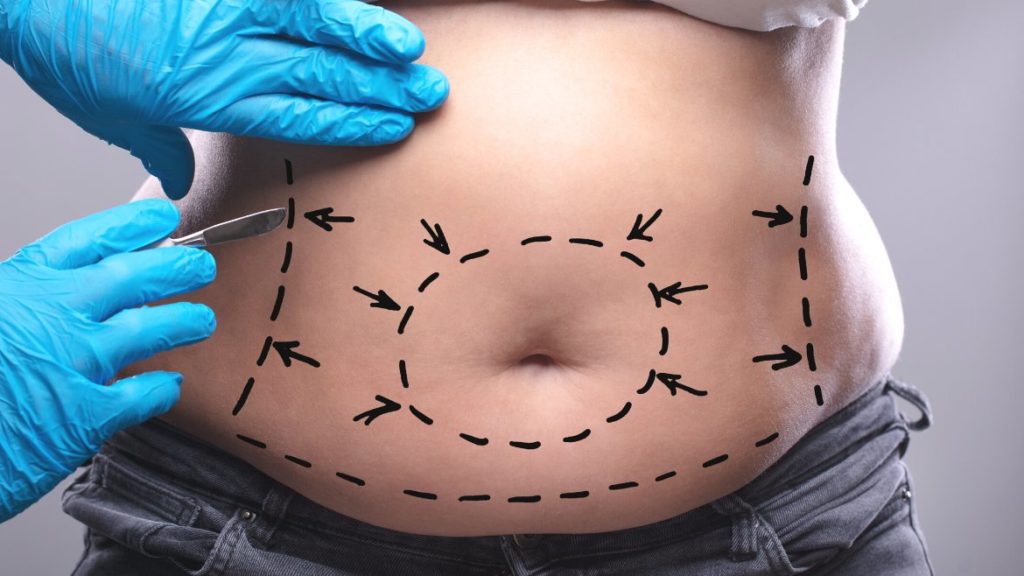 Abdominoplastia En Sevilla Abdomen Plano Y Firme